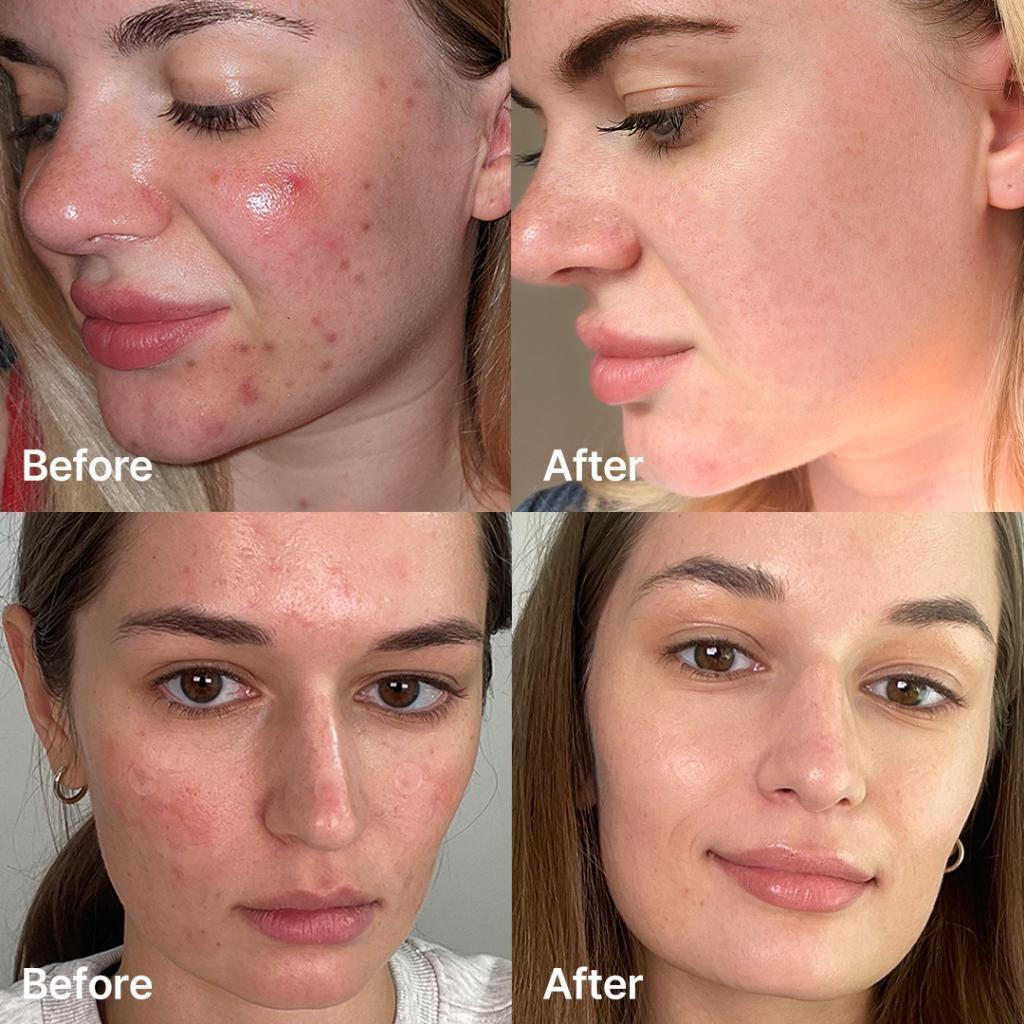 Medicube Red Succinic Acid Serum Προσώπου με Νιασιναμίδη για Ακμή 30ml
